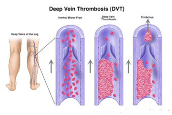 minimize-risk-for-Deep-Vein-Thrombosis